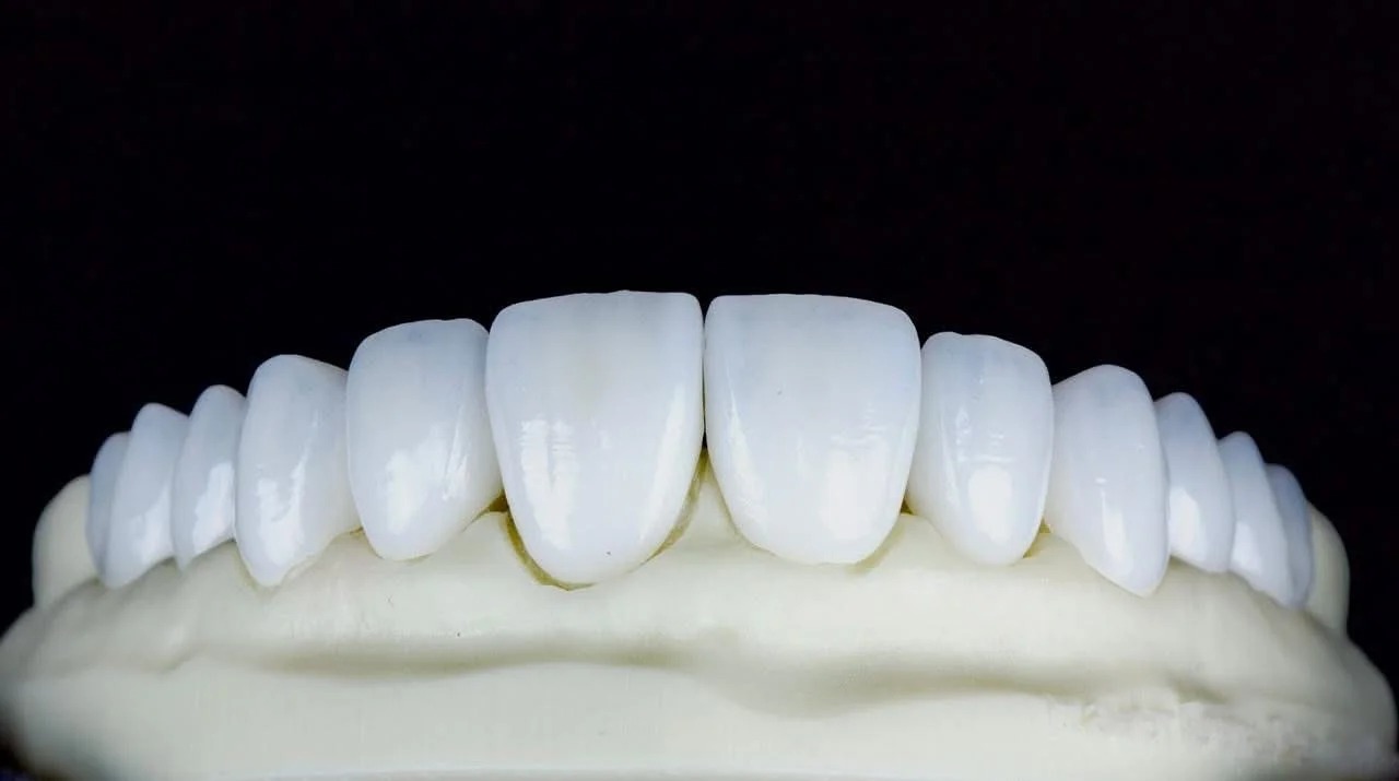 After treatment: hand-crafted porcelain restorations highlighting the true artistry of modern dentistry through their intricate surface texture, layered translucency, and functional precision.